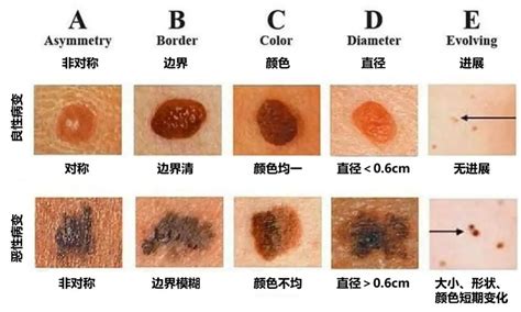 身体痣|为什么身上突然长出新痣？容易恶变吗？